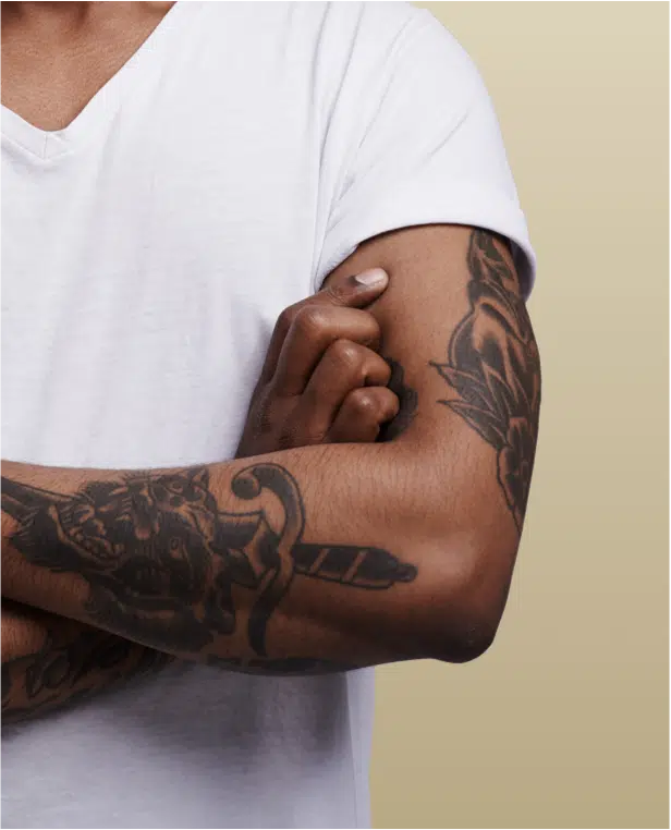 Tattoo Removal