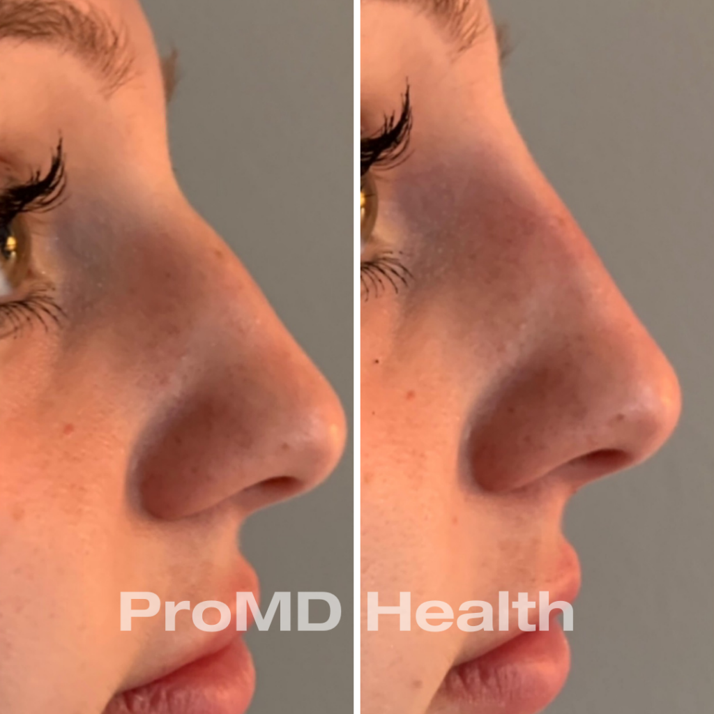 Filler - Non Surgical Nose Job