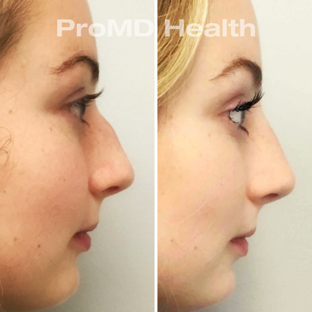 Filler - Non Surgical Nose Job