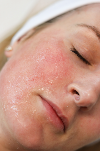 Skin Rejuvenation Announcement ProMD Health mobile