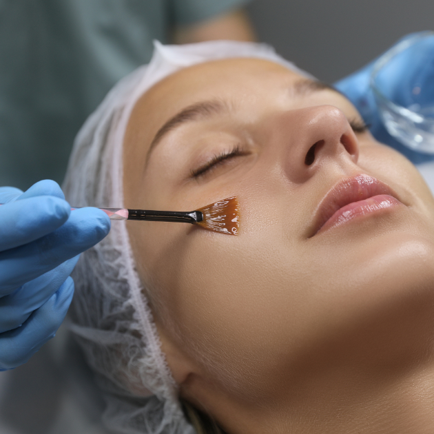 Chemical Peel