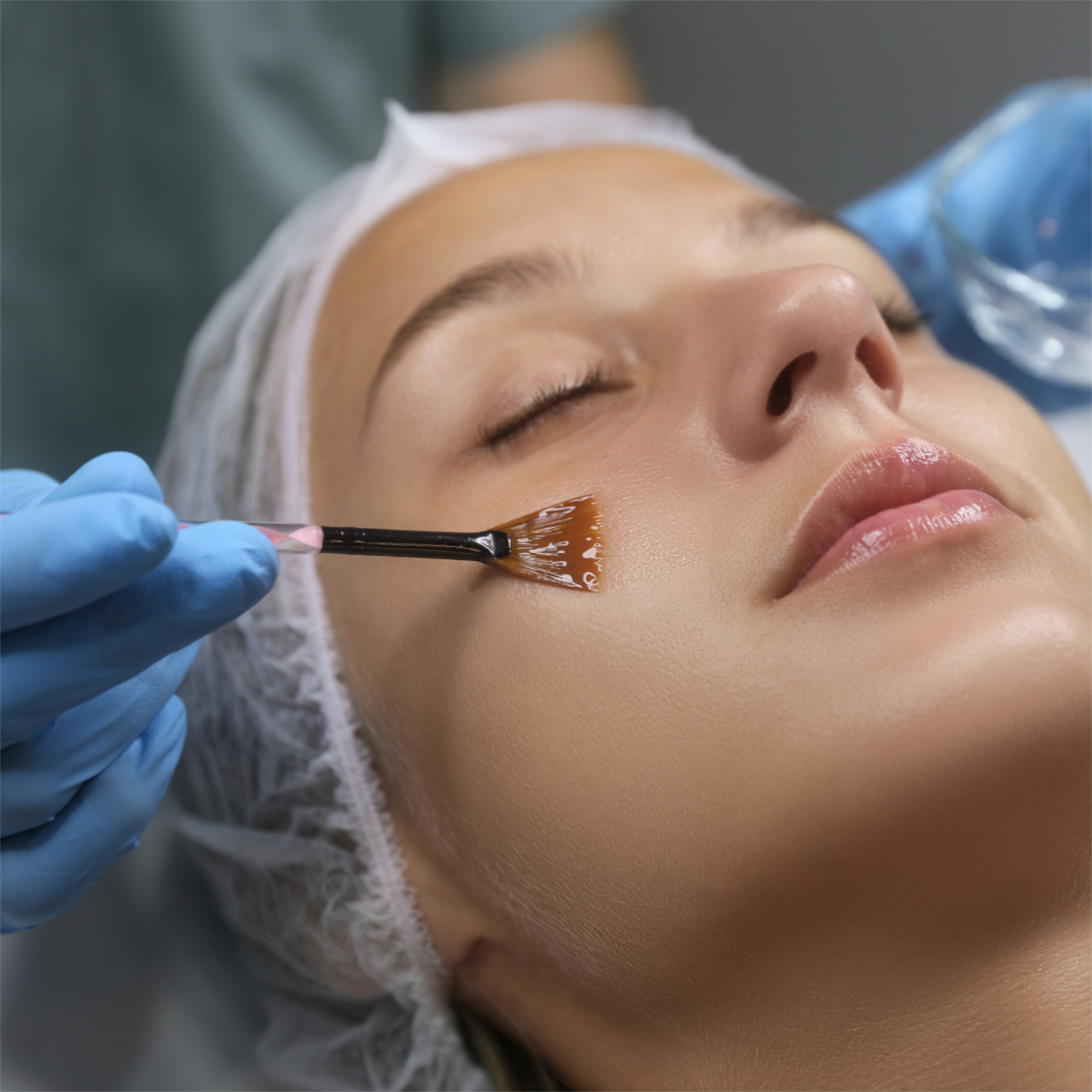 Chemical Peel
