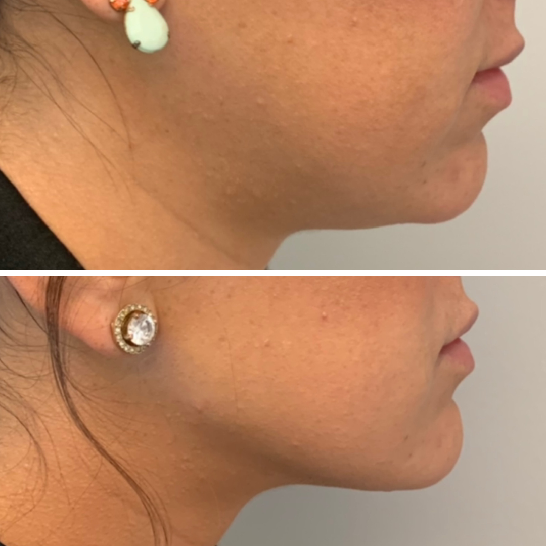 The-Kybella®-Experience-at-ProMD-Health
