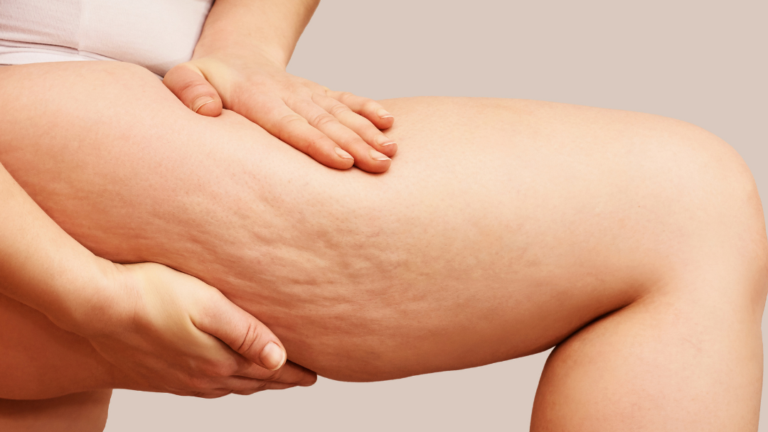 Avéli™ Cellulite Treatment with Dr. Gavrila and Amanda Pittillo, PA-C