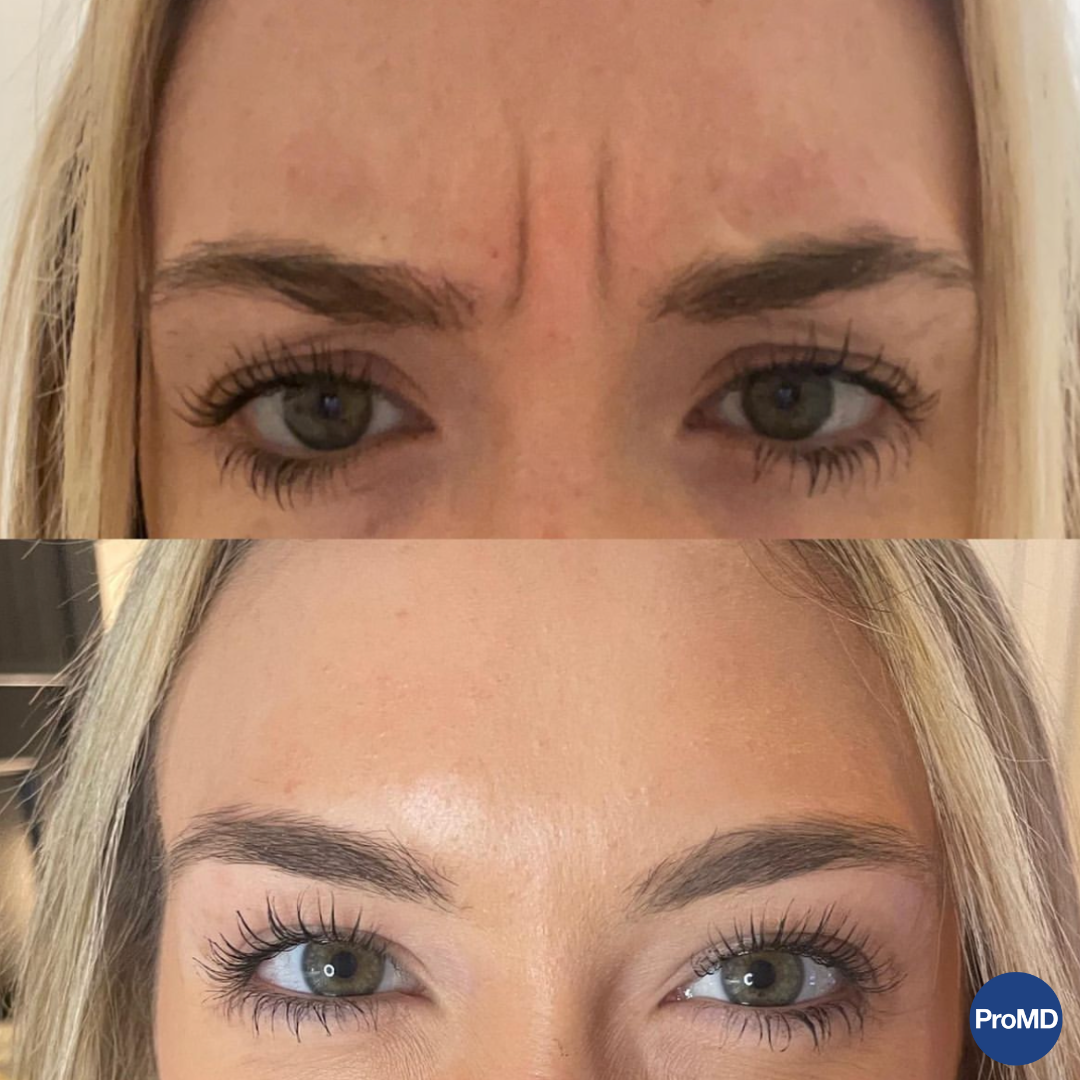 Real patient Botox results — ProMD Health Hutto