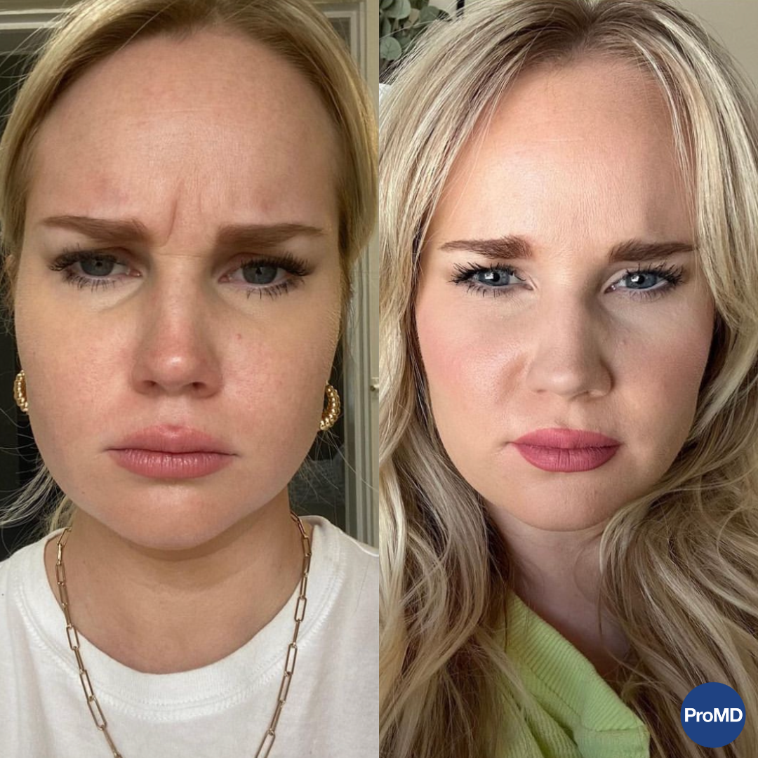 Real patient Botox results — ProMD Health Hutto